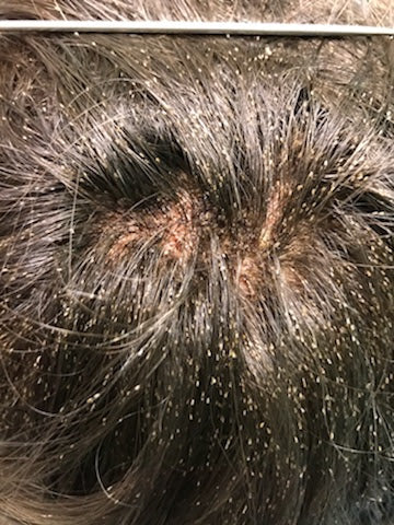 Repel lice naturally with our 100% natural lice repellent spray. Infused with essential oils like Tea Tree, Neem, Lavender, Peppermint, Rosemary, and Vanilla Extract. Safe for all hair types, clothes, hats, and bedding. Cruelty-free and free from pesticides, phthalates, formaldehyde, and parabens.
